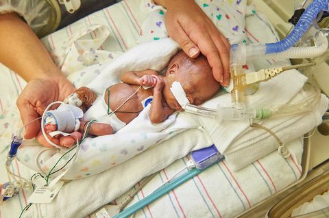 Ein zu früh geborenes Baby im Children's Hospital of Philadelphia in Philadelphia, USA