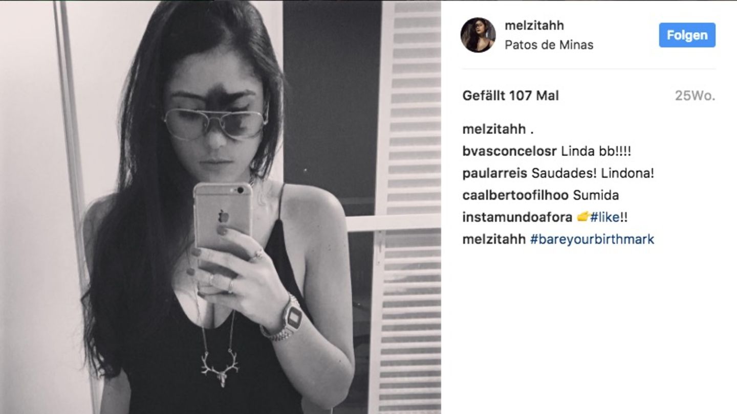 Die 24-jährigen Mariana Mendes macht ein Spiegel-Bild von sich, das ihr Muttermal zeigt