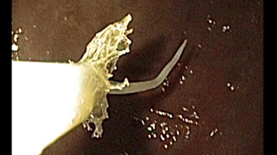 Erbrechen, Fieber, Bauchschmerzen: Die Larve wird mit einem Instrument entfernt Die Larve wird mit einem Instrument entfernt