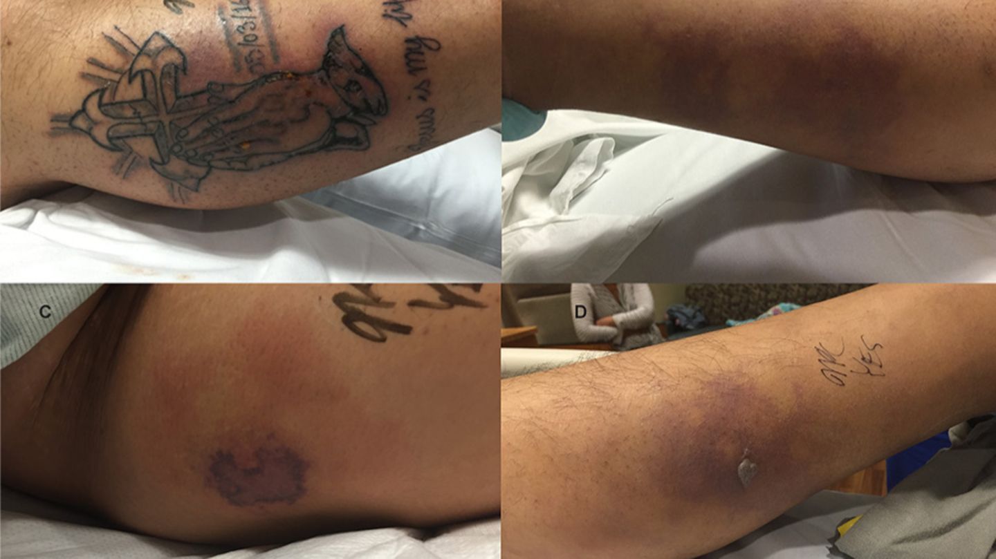 Der 31-jährige Mann hatte sich ein Kreuz und zum Gebet gefaltete Hände tätowieren lassen und ging fünf Tage später im Meer baden - mit fatalen Folgen