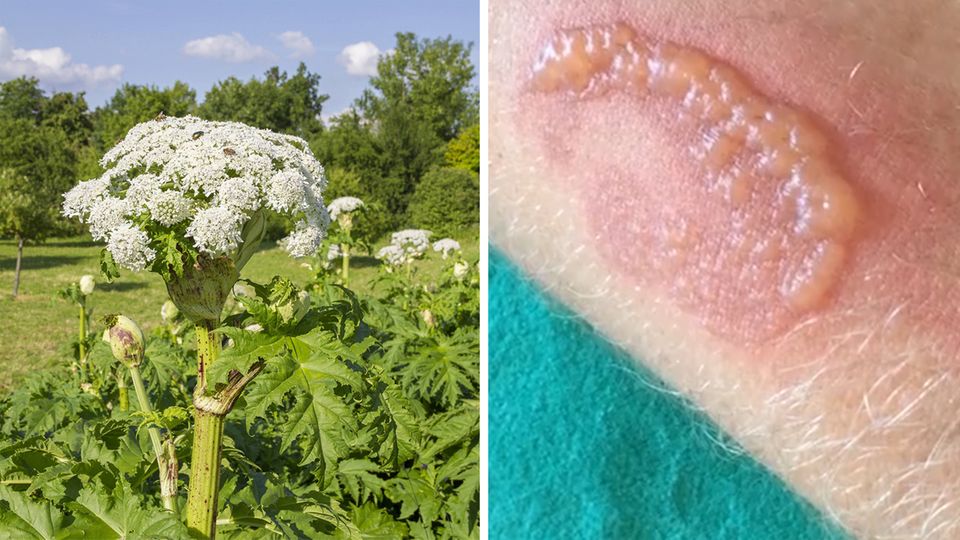 Riesenbärenklau im Selbstversuch: So gefährlich wirkt die Pflanze