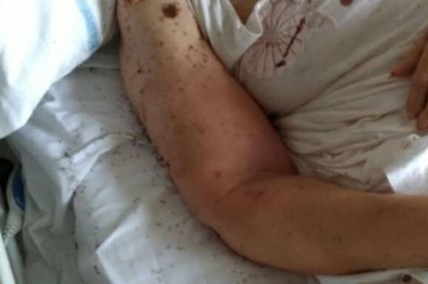 Kribbeln im Krankenzimmer: Ameisen überrennen ein Patientenbett in einer Klinik in Neapel