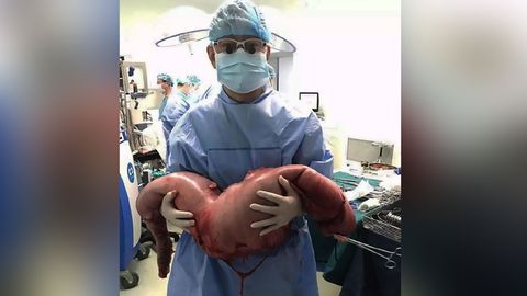 Nach der OP hält ein Arzt das entfernte Stück Darm mit 13 Kilogramm Fäkalien in die Kamera