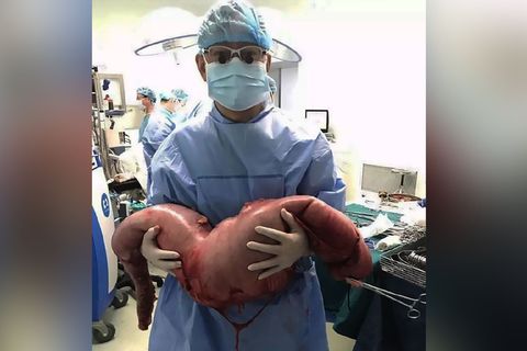 Nach der OP hält ein Arzt das entfernte Stück Darm mit 13 Kilogramm Fäkalien in die Kamera