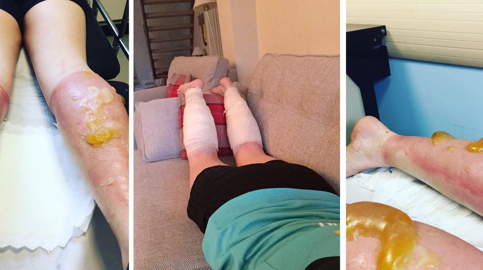 Brandblasen nach Sonnenbrand