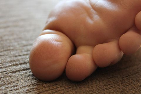 Wie lassen sich Warzen am besten entfernen?