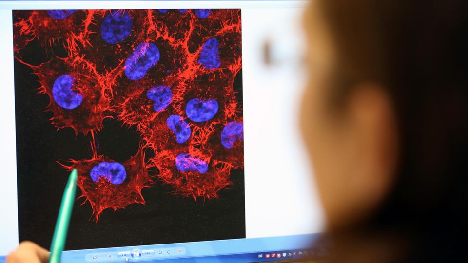 Forscher arbeiten daran, mit der Gentherapie verschiedene Arten von Krebs bekämpfen zu können (Symbolbild)