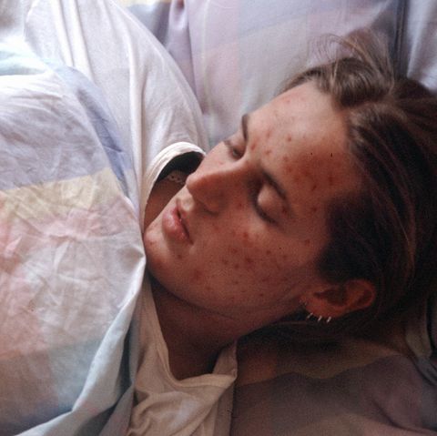 Eine Frau mit Masern-Erkrankung liegt in einem Bett