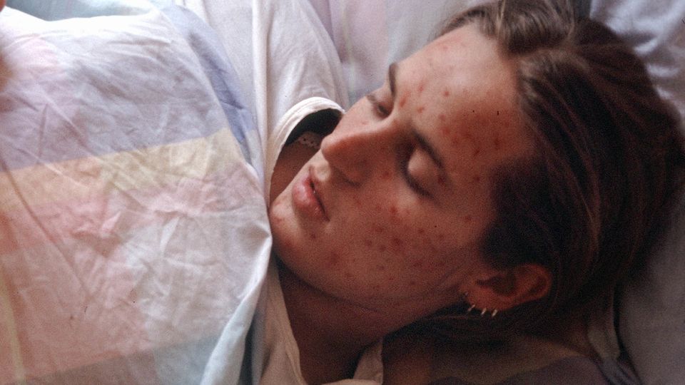 Eine Frau mit Masern-Erkrankung liegt in einem Bett