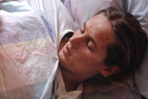 Eine Frau mit Masern-Erkrankung liegt in einem Bett