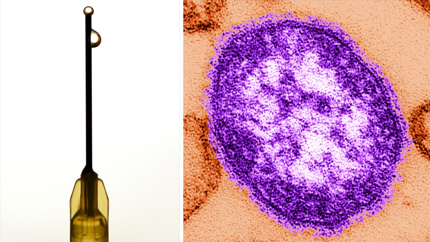 Masern schwächen das Immunsystem und können zu Folgekrankheiten führen