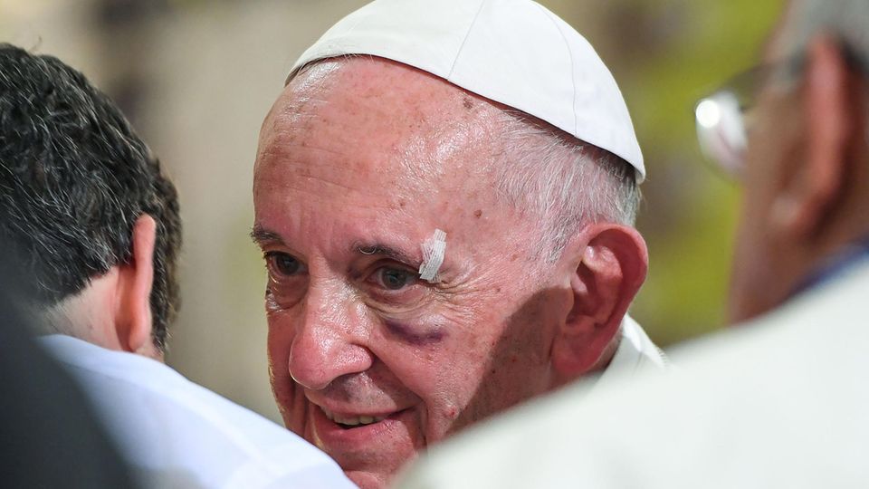 Papst Franziskus mit blauem Auge