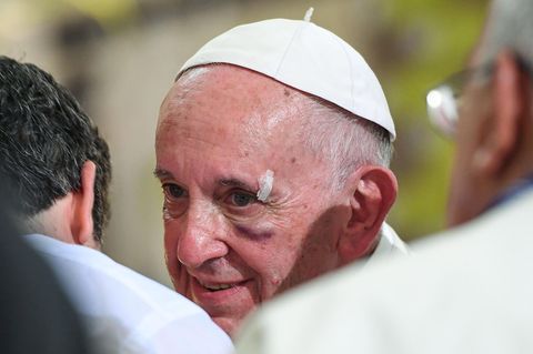 Papst Franziskus mit blauem Auge