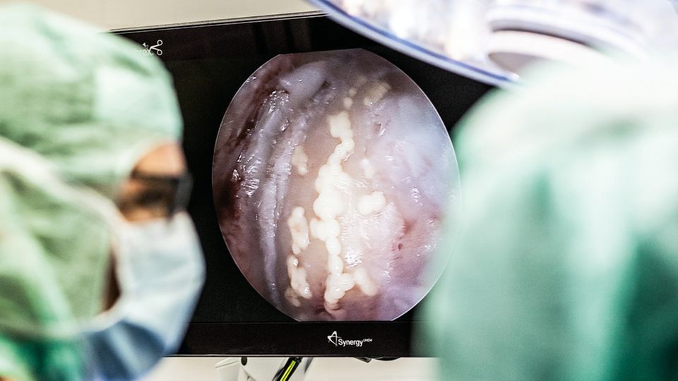 Einsetzen: In die gereinigte Knorpellücke werden die die gezüchteten Zellen gepflanzt