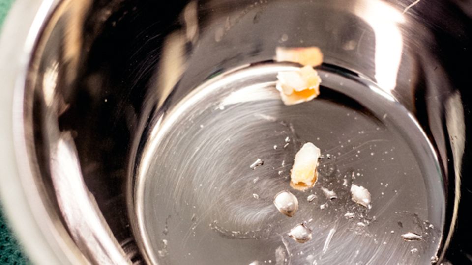 Rohstoff: die Knorpelpartikel, unmittelbar nach der ersten Operation