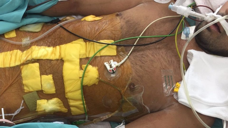 Elias Go Fund Me Elias im Krankenhaus in Thailand