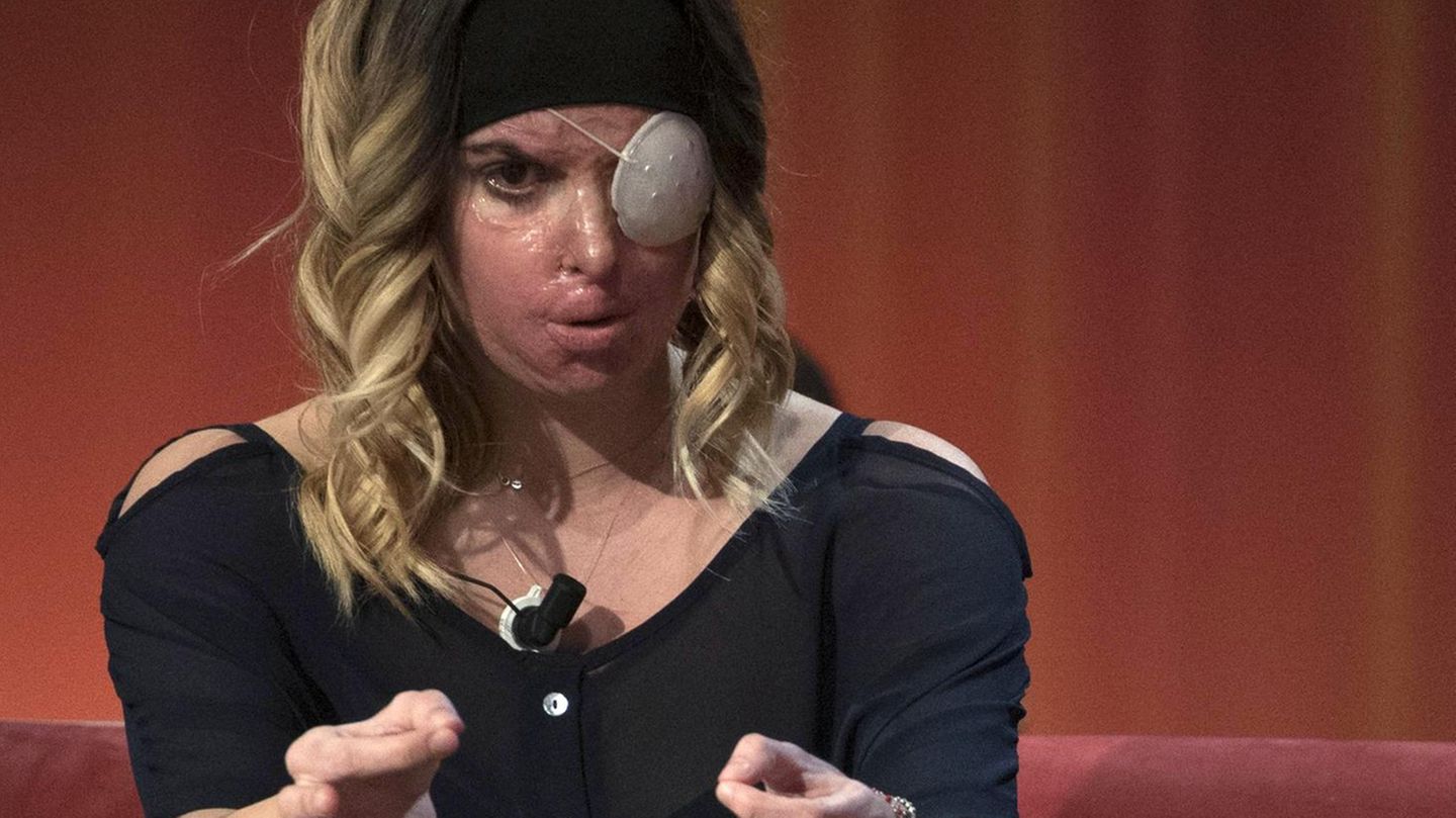 Gessica Notaro nach dem Säureangriff: Im April zeigte sie im italienischen Fernsehen zum ersten Mal ihr Gesicht