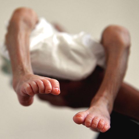 Ein unterernährtes, drei Monate altes Baby im Ernährungszentrum eines Krankenhauses in Sanaa, der Hauptstadt des Jemen