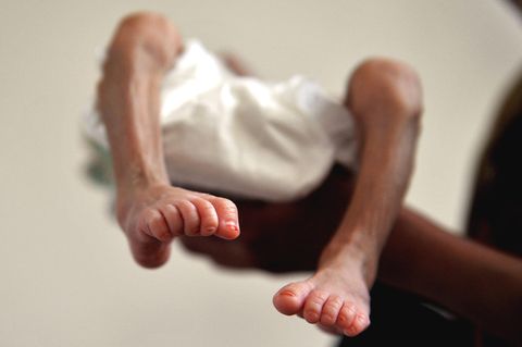 Ein unterernährtes, drei Monate altes Baby im Ernährungszentrum eines Krankenhauses in Sanaa, der Hauptstadt des Jemen