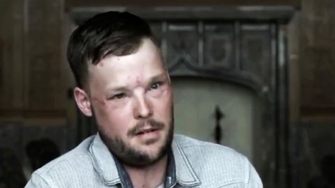 Transplantation: Ärzte verpflanzen erstmals ein Gesicht