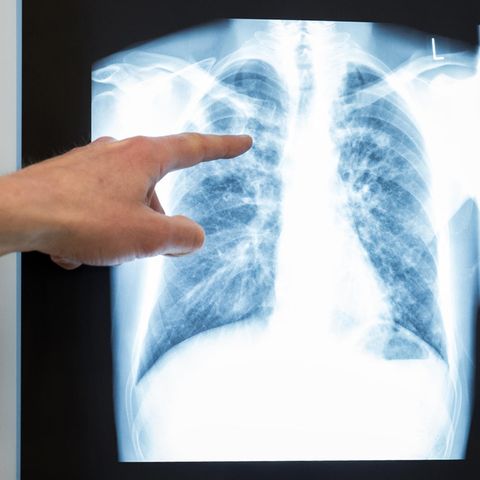 In Dresden haben sich zwölf Schüler mit dem Tuberkulose-Erreger angesteckt