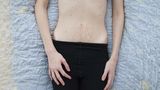 Linda ist bereits seit Jahren von Anorexie (Magersucht) und Bulimie betroffen