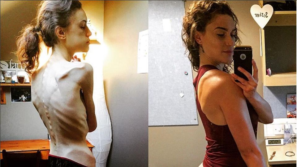 Zu ihren schlimmsten Zeiten wog Emelle Lewis nur noch knapp über 30 Kilogramm Emelle Lewis mit 30 kg Körpergewicht und mit 55 kg Körpergewicht
