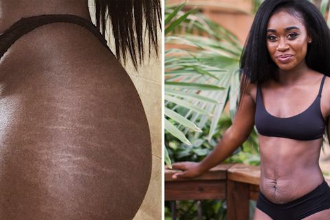 "Warum sieht dein Bauch so aus?": Junge Mutter feiert ihre Dehnungsstreifen mit sexy Fotoshooting