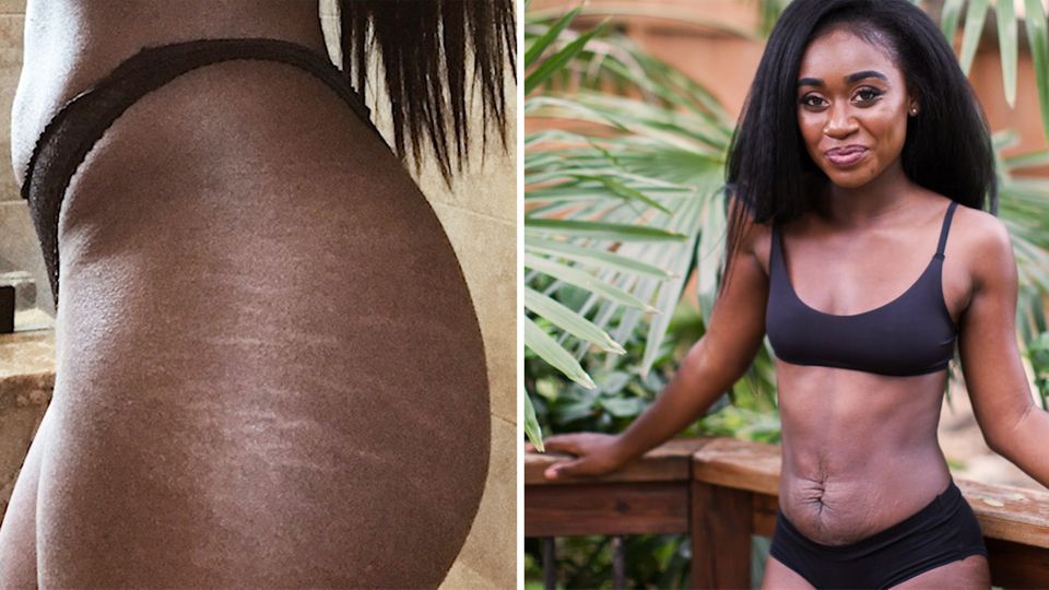 "Warum sieht dein Bauch so aus?": Junge Mutter feiert ihre Dehnungsstreifen mit sexy Fotoshooting