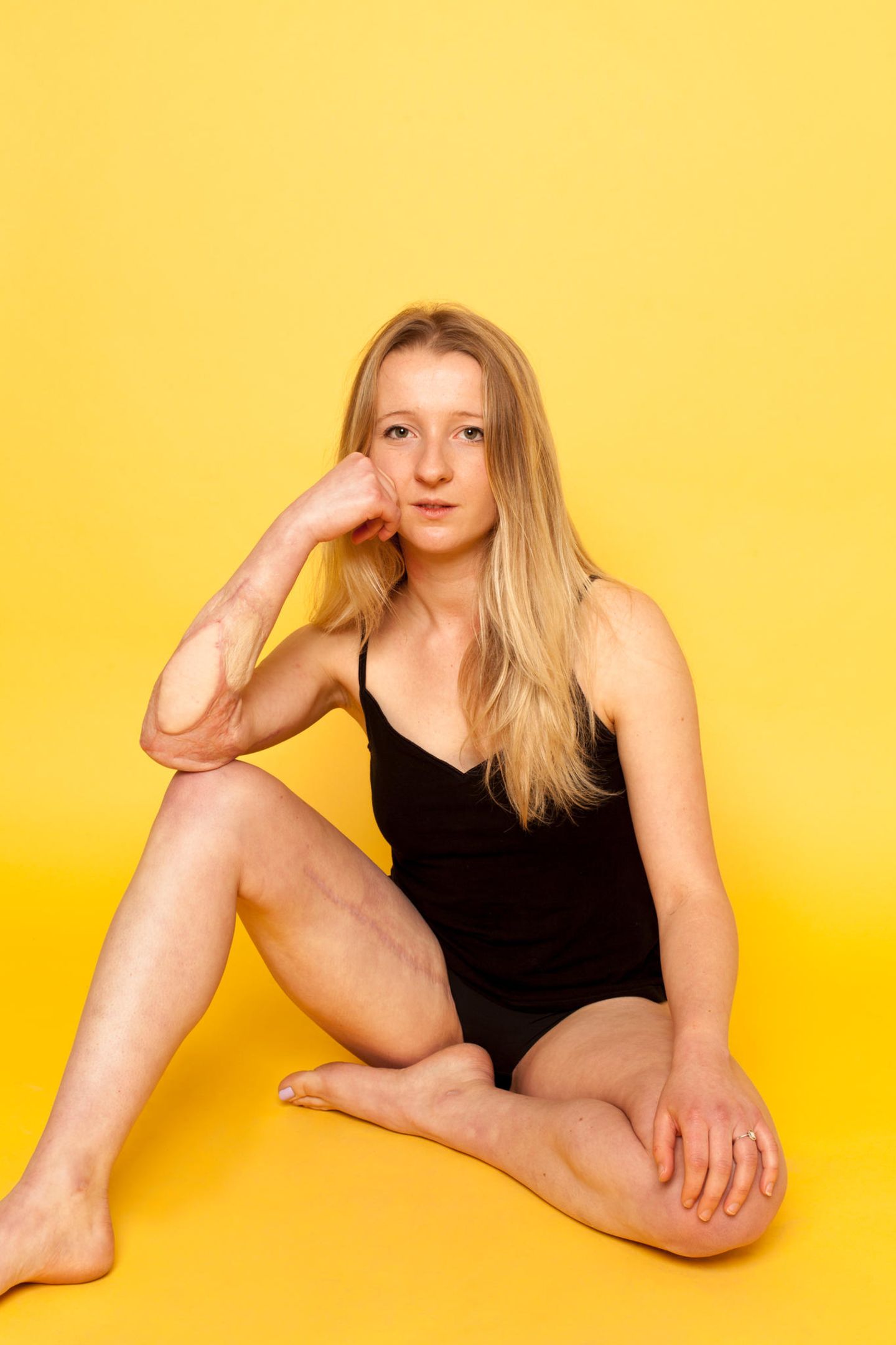 Anna - Das ist die Geschichte ihrer Narben