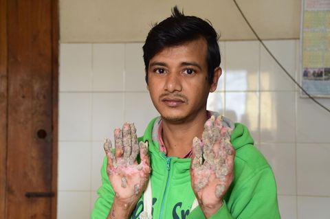 Abul Bajandar aus Bangladesch