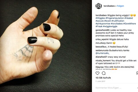 EIn Foto einer Hand mit amputiertem kleinen Finger