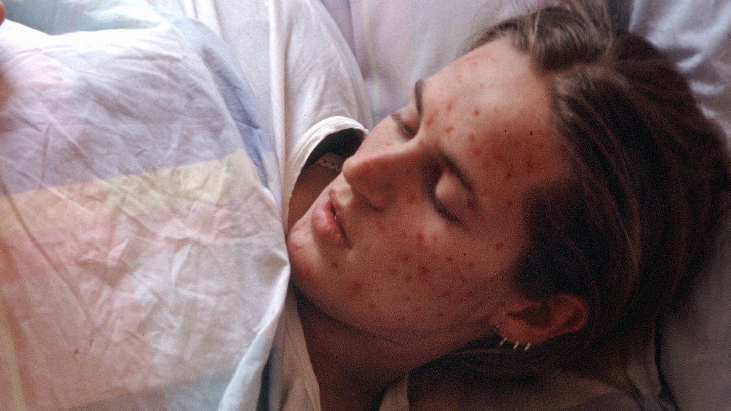 WHO-Bilanz zu Masern-Erkrankungen: Eine an Masern erkrankte Frau liegt im Bett