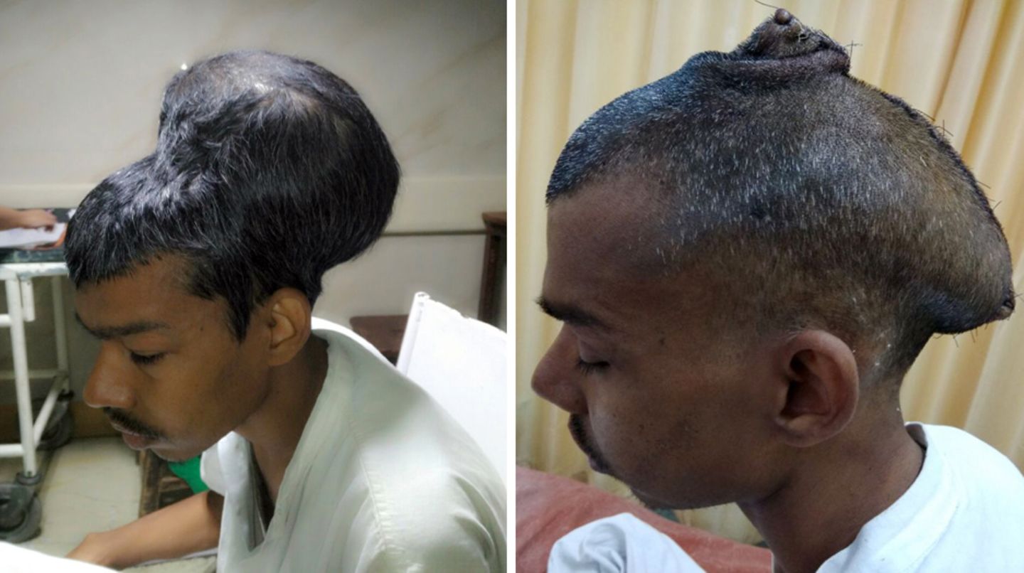 Im Nair Hospital in Indien wurde diesem 31-Jährigen ein fast zwei Kilogramm schwerer Hirntumor entfernt (r. nach der OP)
