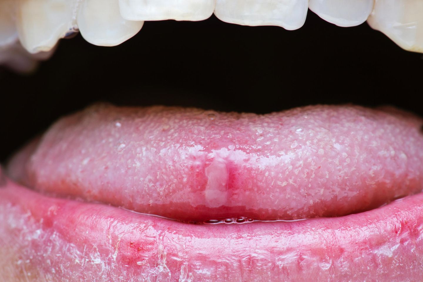 Aphthen sind schmerzhaft und treten meist an Lippe oder Zunge auf. 