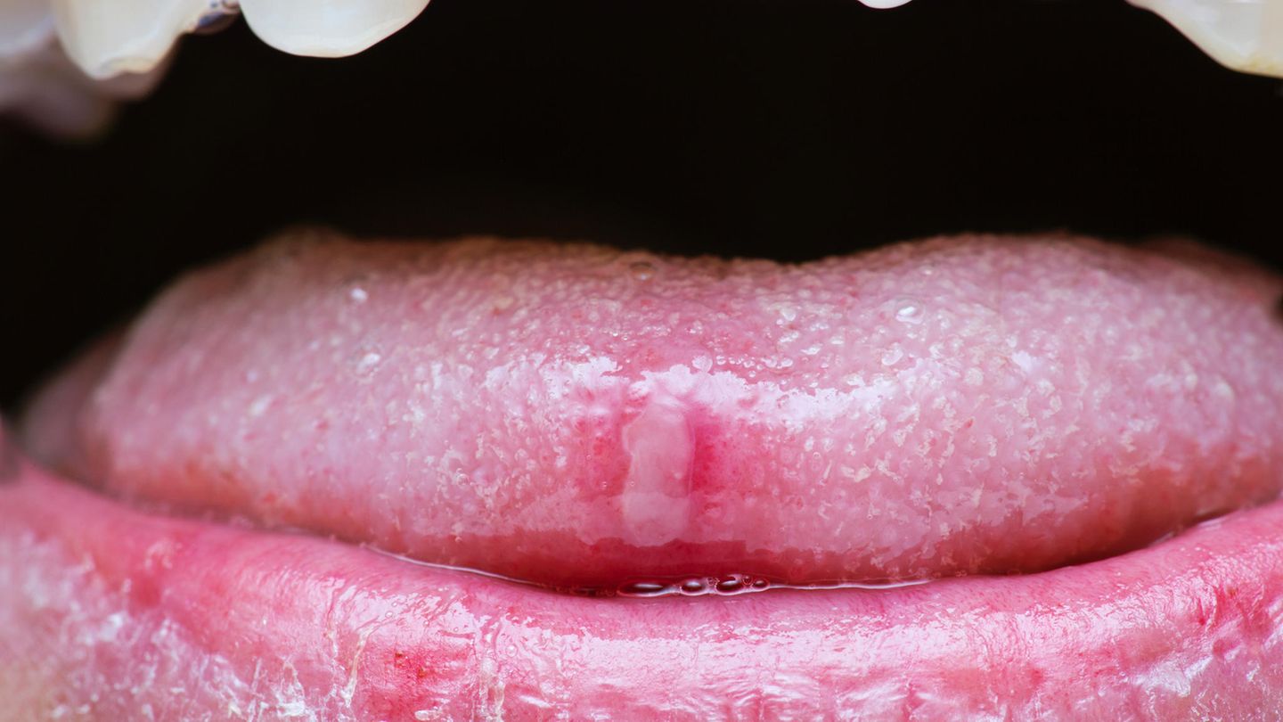 Lippe der pickelchen auf 5 Tipps