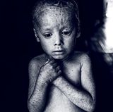 Lucas, sechs Jahre alt. Er wurde mit Ichthyose geboren, einer Krankheit, die seine schuppige Haut immer wieder reißen und aufplatzen lässt