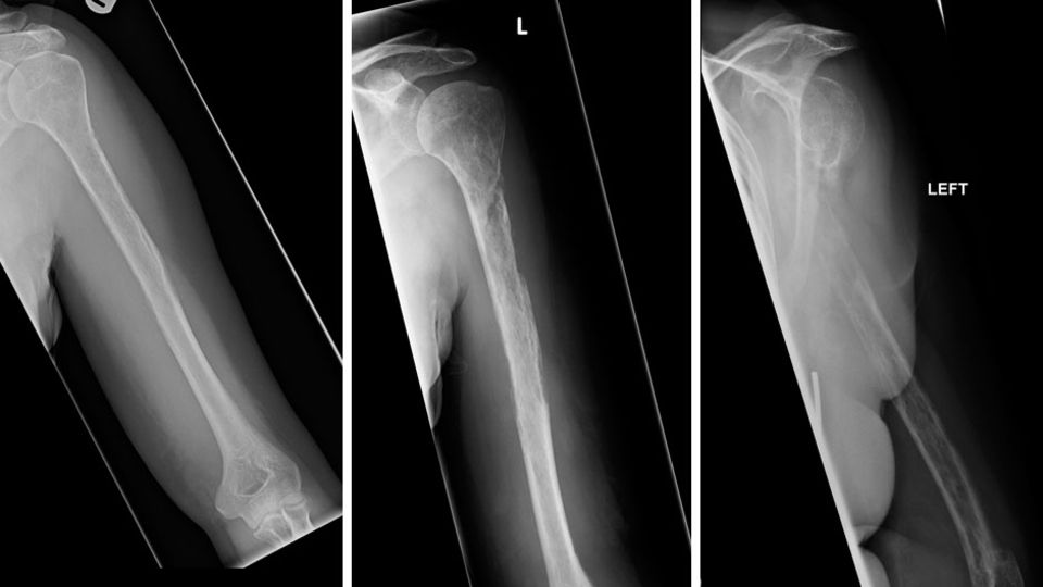 Röntgenaufnahme des linken Oberarmknochens - beim ersten Arzttermin (links), nach einem Jahr (Mitte) und nach drei weiteren Monaten (rechts)