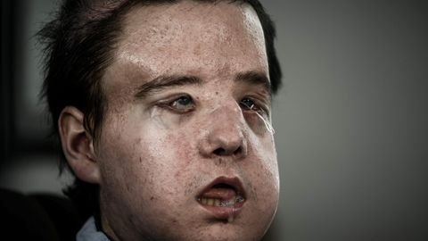 Jérôme Hamon nach seiner ersten Operation