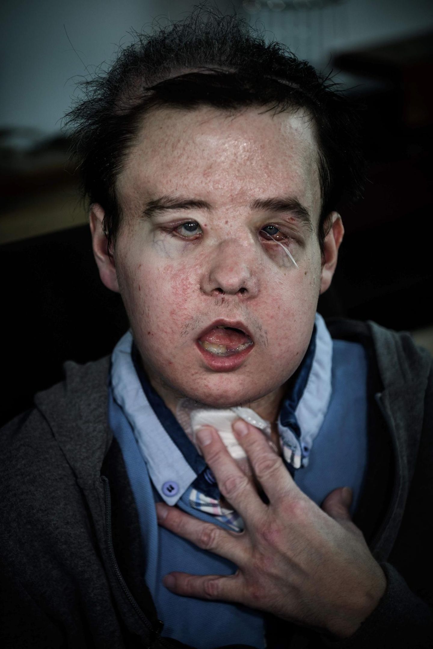 Portrait von Jérôme Hamon nach Operation