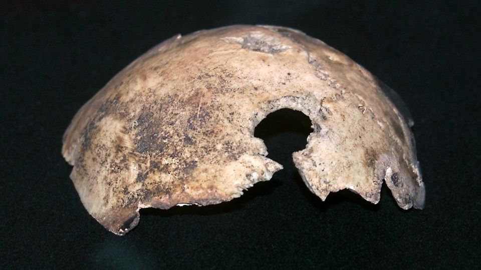Adolf Hitler - Fragment der Schädeldecke mit Durchschussloch Adolf Hitler - Fragment der Schädeldecke mit Durchschussloch