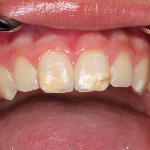 Zahnärzte warnen vor Kreidezähnen Kreidezähne bei einem Kind