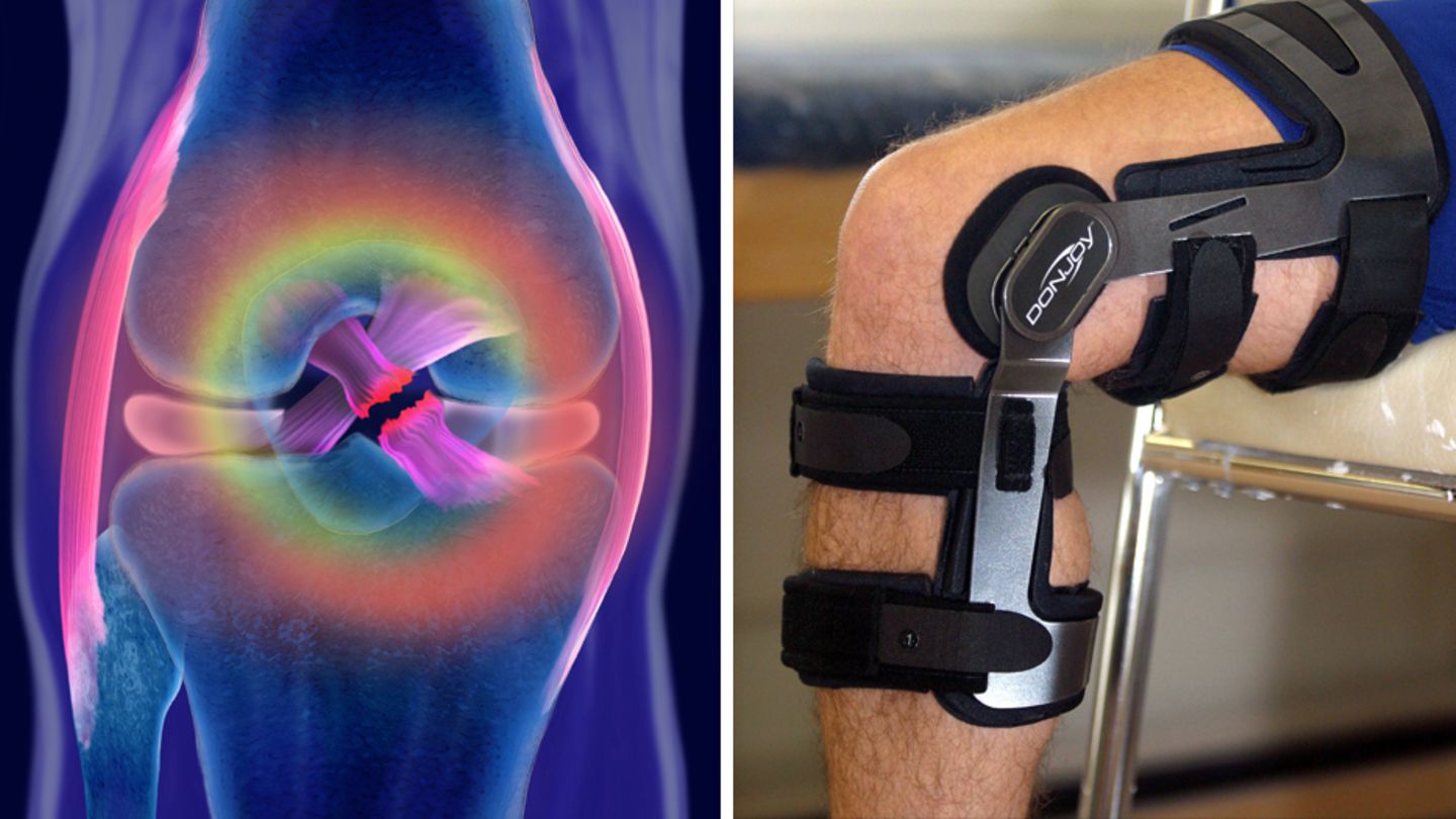 Nach Kreuzbandriss: Operieren oder nicht? Ein Glaubenskrieg ums Knie