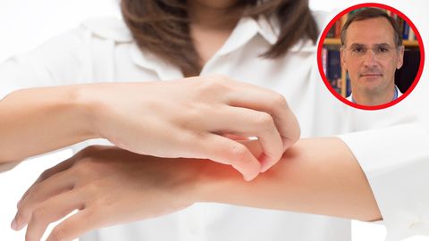 "Kein Patient ist wie der andere": Was hilft (wirklich) gegen Neurodermitis? - Experte klärt auf
