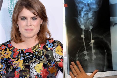 Prinzessin Eugenie zeigte auf Instagram Röntgenbilder ihrer Wirbelsäule