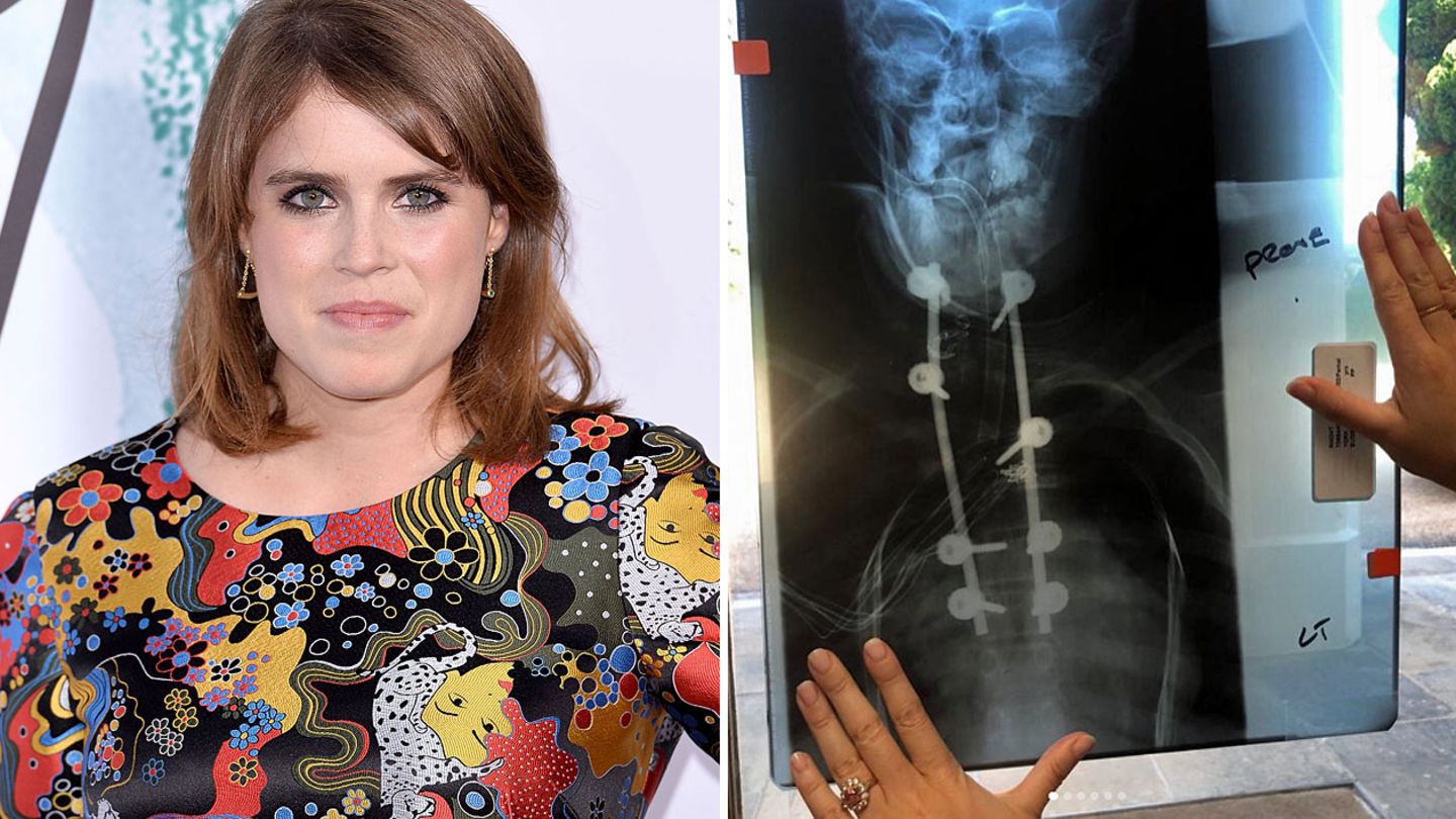 Prinzessin Eugenie zeigte auf Instagram Röntgenbilder ihrer Wirbelsäule