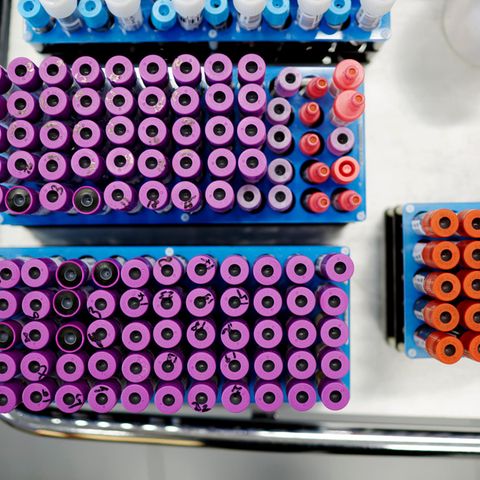 Patientenröhrchen warten während der Durchführung eines HIV-Suchtests auf die Weiterverarbeitung