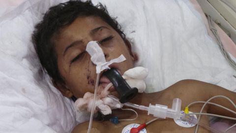 Ein Junge, der den Luftangriff auf den Schulbus überlebt hat, liegt in einem Krankenhaus im Jemen