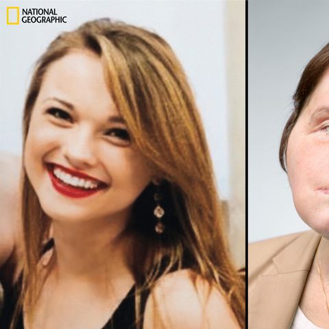 Links ist Katie Stubblefield 17 – acht Monate vor ihrer Selbstverletzung. Rechts ist Katie 22 – 13 Monate nach ihrer Gesichtstransplantation.