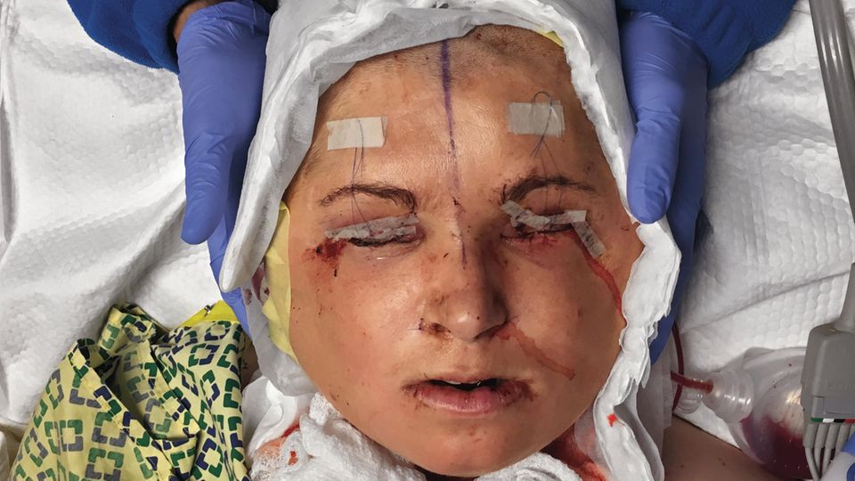 Katie Stubblefield Ein Krankenhausmitarbeiter hält vorsichtig Katies Kopf nach der 31-stündigen Operation. Um ihre Augen zu schützen wurden die Augenlider zugenäht.